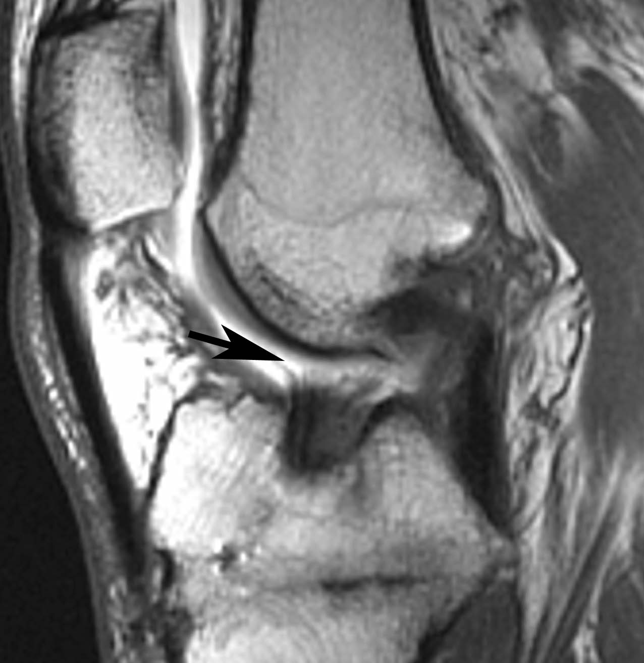 Figure 2 for case Disrupted ACL graft